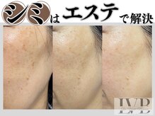 ラヴレボーテ(La Vraie Beaute)の雰囲気（加工なし、当サロンのシミケア改善症例）