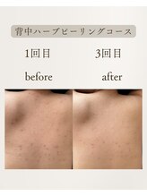 きぃ オリジンプラス(きぃ origin+)/背中ハーブピーリング