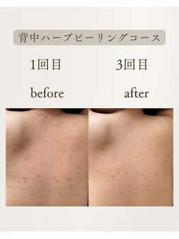 きぃ オリジンプラス(きぃ origin+)/背中ハーブピーリング