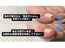 巻き爪矯正初回で変化を実感！