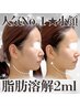 【平日限定★10:30-15:00】人気No.1◎"脂肪燃焼"2ml ¥28,600→¥22,000