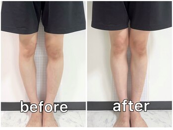 サンク(Cinq)/【整体+O脚矯正】O脚改善