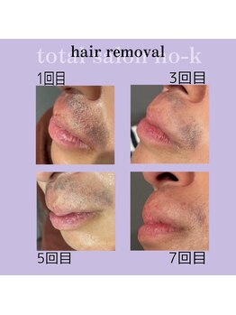 ヌック(NO-K)/ヒゲ脱毛