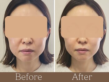 アントルーチェ 代々木上原(Entluce.)/脂肪分解でフェイスラインをget!