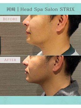 ストリクス(STRIX)/before / after【ヘッドスパ】