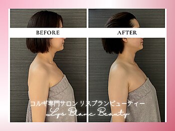 リスブランビューティー(Lys Blanc Beauty)/９０分コルギBefore×After