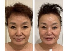 ドクターボディクリスタル(Dr.Body Crystal)の雰囲気(70代 お悩み 眉間のしわ/ほうれい線/マリオネットライン)