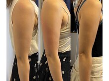 グラナーダ(granada)/気になる二の腕集中攻撃