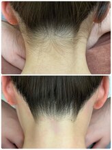 ビューティーグロウ(BEAUTY-GROW)/うなじ脱毛