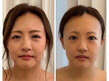 美人バスト 赤羽店/【小顔コルギ症例】