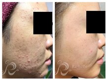 パルファンカルム 駅西本町店/剥く、ではなく代謝の促進！