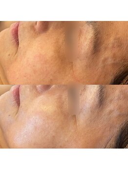 ヴィアス(Vias)/プラズマフェイシャル