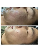 ルビー 池袋店(Ruby)/メンズハーブピーリング