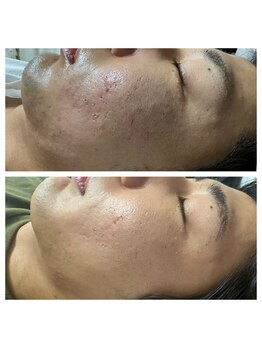 ルビー 池袋店(Ruby)/メンズハーブピーリング