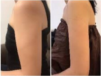 アリス 赤坂/2カップ5回合計10カップ