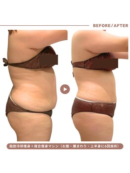 イエス マイサロン(yes My Salon)の写真/【脂肪に集中攻撃！当店人気No.1の冷却痩身】痩せたい女性はプロにお任せ◎理想のくびれとボディラインに