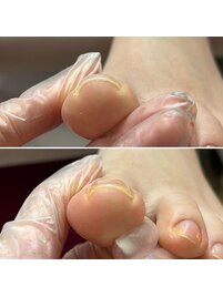 巻爪ケア【Hey Swich】