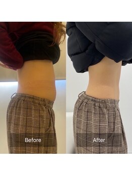 キレピア 熊本インター店(kirepia)/下腹ぽっこりが無くなってます!!