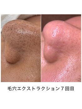 シェソワ(Chez soi)/頑固な黒ずみもここまでキレイに