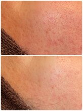 ベベ 金沢本店(Be'be')/お肌変化.2