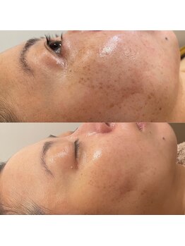 エン(enn)/【小さなシミ緩和】