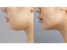 ビルーチェ(美LUCE)/引き締まったシャープな小顔に