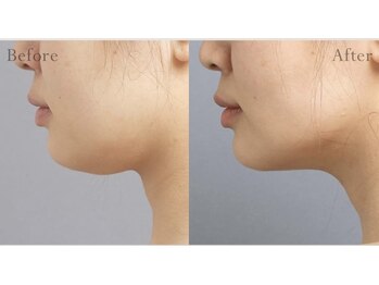 ビルーチェ(美LUCE)/引き締まったシャープな小顔に