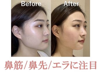 ラプリボーテ(Raplit BEAUTE)/隆鼻＋輪郭矯正40分10回