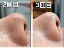 沖 野上鍼灸整骨院/毛穴洗浄