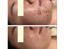 ベルーテエッセンスの雰囲気(ハーブピーリングや毛穴洗浄で根本肌質改善!背中ニキビケアも◎)