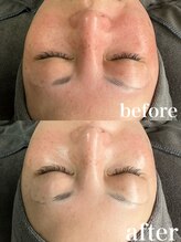 エードット スパ アンド ハーブ(a.spa & herb)/ハーブピーリング