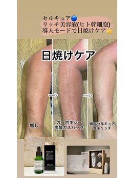 リラマ(Relama)/日焼けにも!!