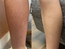 ビューティーリバース 湘南台店/脱毛コースの流れ4 アドバイス