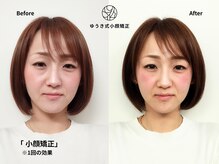 ゆうき式小顔矯正