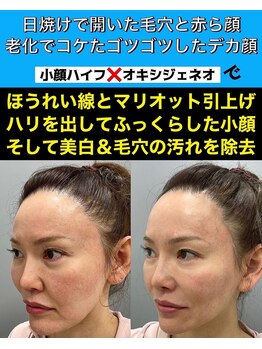 スペチアーレ 夙川/たるみ改善、毛穴引き締めに♪