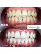 ホワイトニングサロン 名古屋駅店/【ホワイトニング施術例】