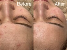 シェリーミル(Cherie Miru)/脂性ニキビ/赤ニキビケア