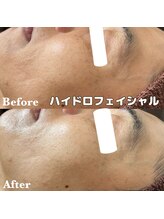 ミノア 大野城店(MINOA)/毛穴洗浄/くすみ/シミ