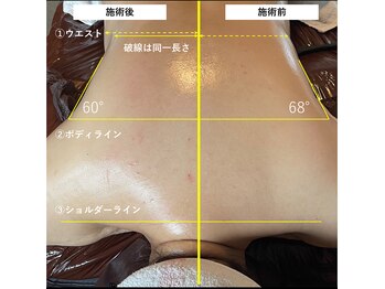 スパークリングセルフ(Sparkling Self)/インディバボディ　施術前後