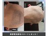 【男性専用】メンズ脱毛　半永久・美容電気脱毛《デザイン脱毛・白髪可◎》