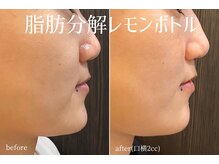 ハティア(hattia)/小顔爆誕！口横ポニョ肉を解消☆