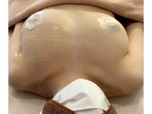 ルミエール(Lumiere)/【倉敷市】バストアップ施術事例