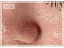 ミリ 千葉店(mili)/鼻の黒ずみ・テカリを改善