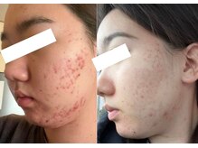 ルポ 那覇(repos)/肌トラブル特化美容鍼100分