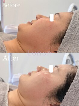 ルノン(Lunon)/毛穴洗浄ハイドロ×ララピール