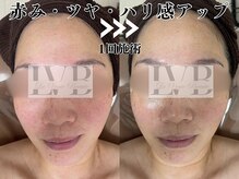 ラヴレボーテ(La Vraie Beaute)の雰囲気（加工なし、当サロンの1回の施術結果・敏感肌/赤み/シミケア/ハリ）