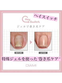 旭川初上陸！ジェルで巻き爪ケア