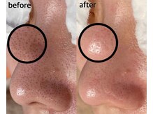 毛穴専科/黒ずみごっそり除去！肌質改善