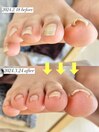 【巻き爪緩和コース】