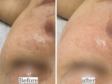 ホーミー(Homie)/毛穴黒ずみ、毛穴開き改善